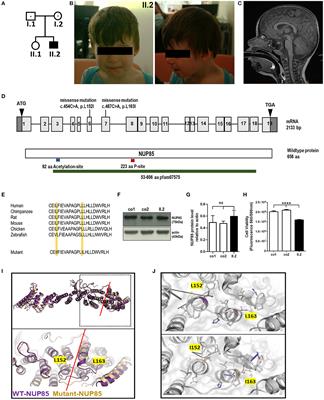 Case report: Compound heterozygous NUP85 variants cause autosomal recessive primary microcephaly